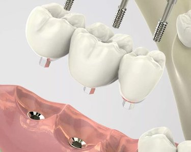 Implantologia stomatologiczna